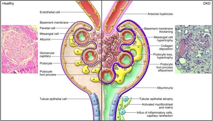 Tại sao Tiểu đường lại Suy thận