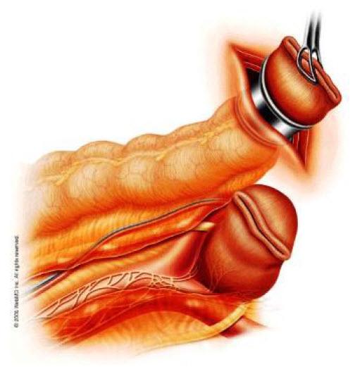 Phẫu thuật cắt đại tràng xích – ma nội soi