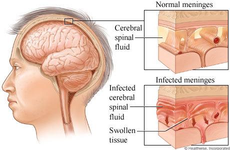 Viêm não – tủy cấp (hội chứng não cấp)