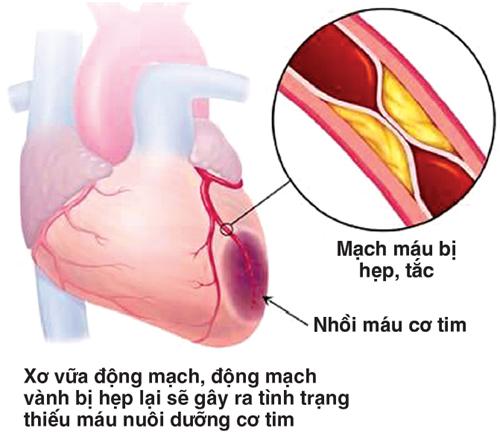 Thiếu máu cơ tim