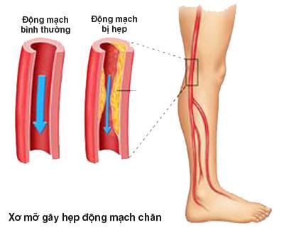 Thoát cốt thư (viêm tắc động mạch chi)