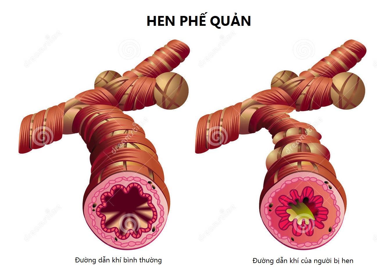 Chi khí quản háo suyễn (hen phế quản)